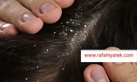قشرة الرأس